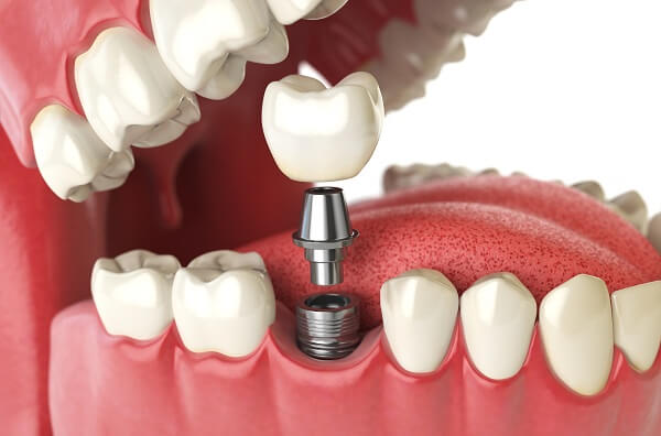 Trồng implant có đau không Trồng implant có đau không